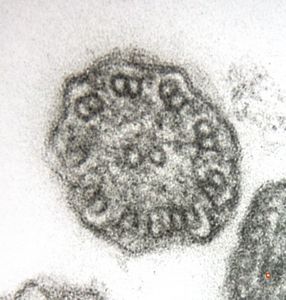 F,5y. | immotile cilia syndrome - nasal mucosa